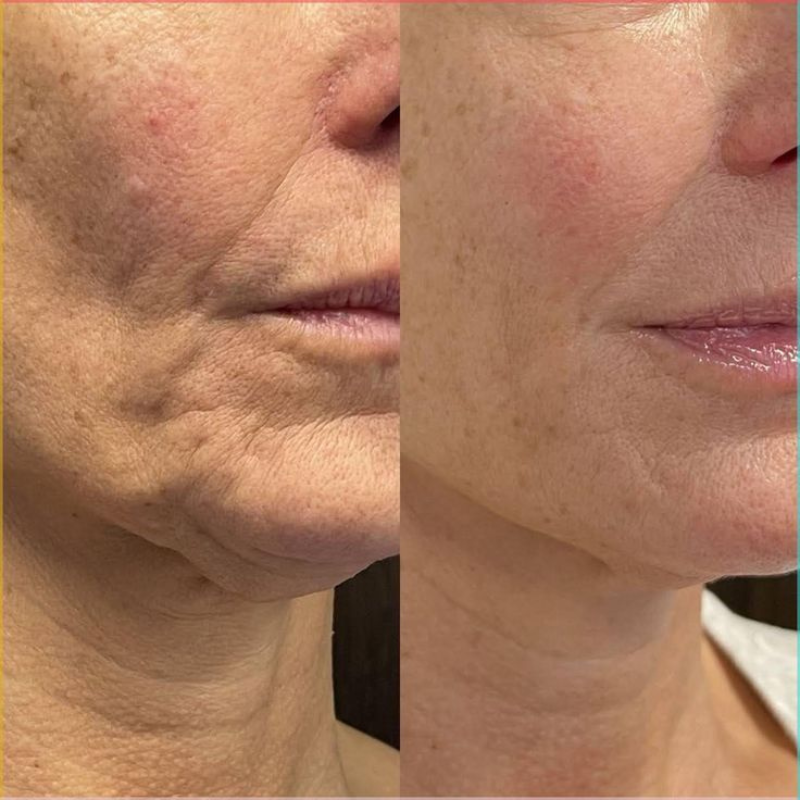 Kit Antiarrugas Dermanix | Tratamiento Coreano