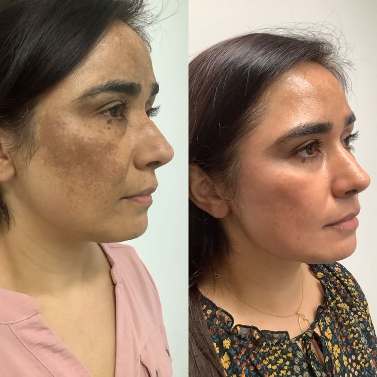 Dermanix Anti-Melasma Kit